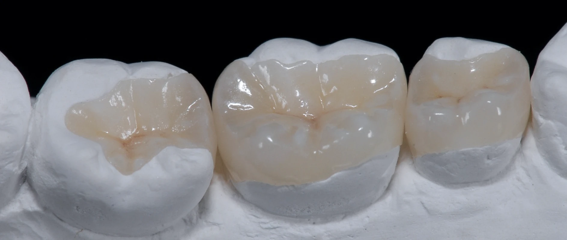 Traitement esthétique à l'aide de composites au cabinet dentaire du Dr Bocquet