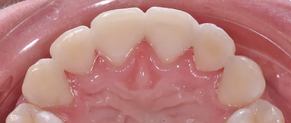 Contentions collées parodontales au cabinet dentaire du Docteur Bocquet