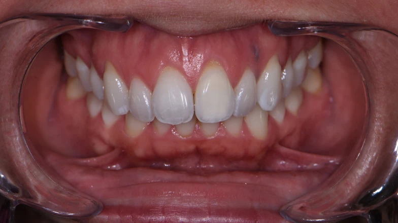 Сas cliniques au cabinet dentaire du Docteur Elodie Bocquet à Douai 59500 : Éclaircissement d'une dent nécrosée