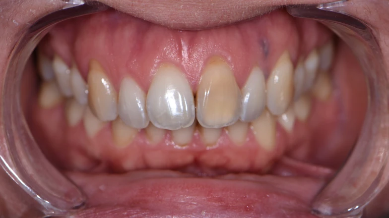 Docteur Elodie Bocquet, chirurgien-dentiste à Douai : Éclaircissement d'une dent nécrosée
