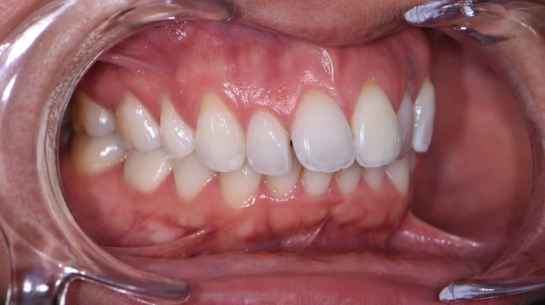 Éclaircissement d'une dent nécrosée au cabinet dentaire du Docteur Elodie Bocquet à Douai 59500