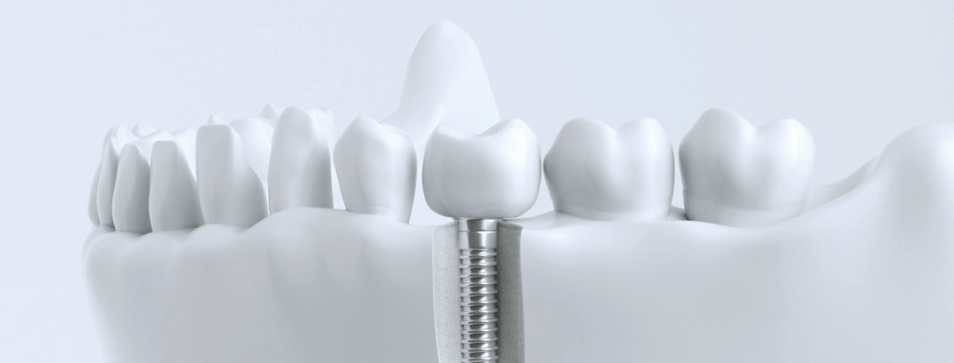 Prothèse sur implant au cabinet dentaire du Docteur Bocquet. Implantologie