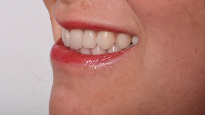 Сas clinique au cabinet dentaire du Docteur Elodie Bocquet à Douai 59500 : cas mixte esthétique