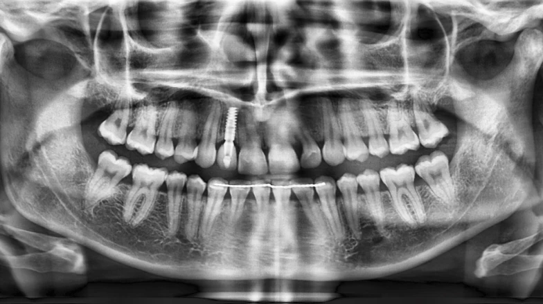 Сas clinique au cabinet dentaire du Docteur Elodie Bocquet à Douai : couronne sur implant