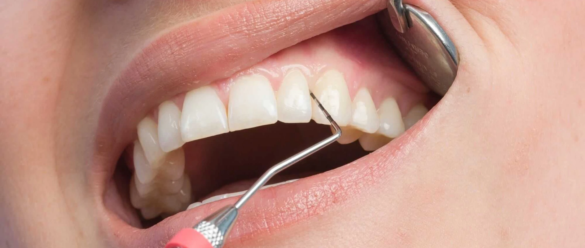 Traitement des maladies parodontales ou "déchaussement dentaire"au cabinet du Dr Bocquet à Douai
