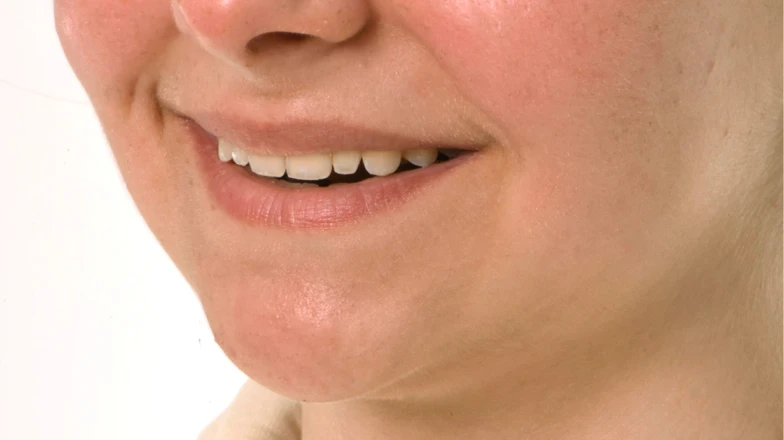 Сas cliniques au cabinet dentaire du Docteur Elodie Bocquet à Douai : facettes sur les dents 12 et 22