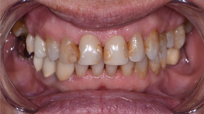 Сas cliniques au cabinet dentaire du Docteur Elodie Bocquet à Douai 59500 : facettes de composite