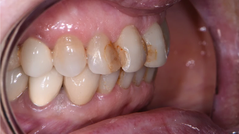 Сas cliniques au cabinet dentaire du Docteur Elodie Bocquet : facettes de composite