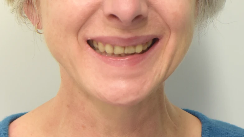 Сas cliniques au cabinet dentaire du Docteur Elodie Bocquet à Douai 59500 : Facettes céramiques usure sans éclaircissement