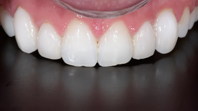Сas cliniques au cabinet dentaire du Docteur Elodie Bocquet à Douai 59500 : facettes sur les dents 12, 13, 22, 23