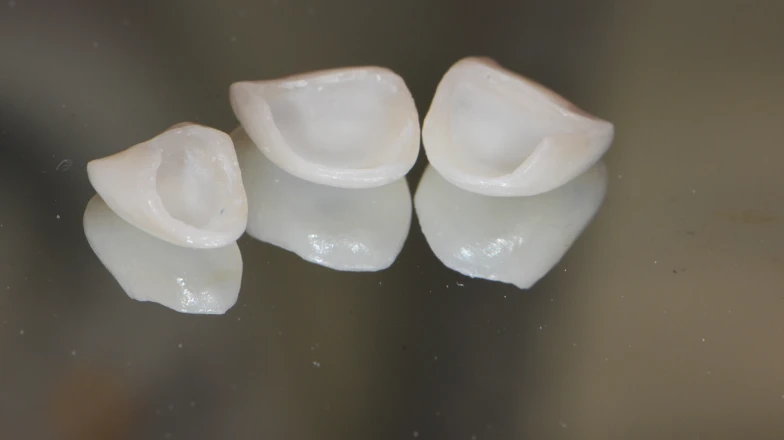 Сas cliniques au cabinet dentaire du Docteur Elodie Bocquet à Douai 59500 : facettes dentaires