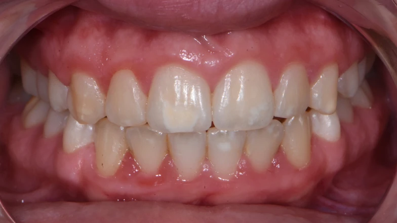 Сas clinique au cabinet dentaire du Dr Elodie Bocquet à Douai 59500 : taches blanches seules