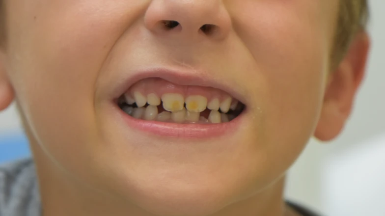 Taches blanches enfant trauma : cas cliniques au cabinet dentaire du Docteur Elodie Bocquet à Douai 59500