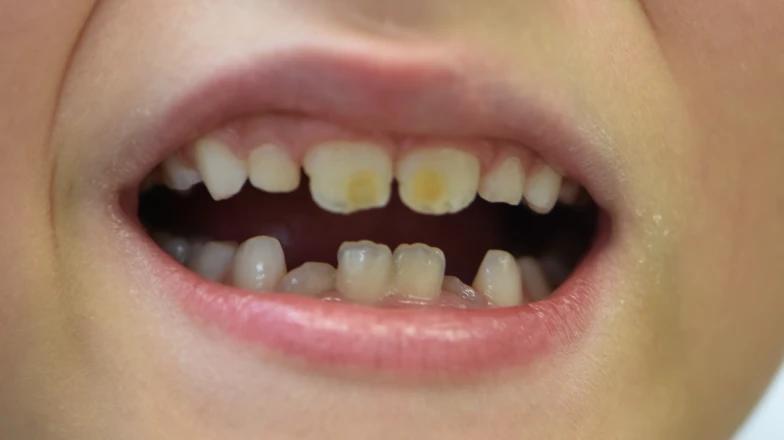 Сas cliniques au cabinet dentaire du Docteur Elodie Bocquet à Douai 59500 : Taches blanches enfant trauma