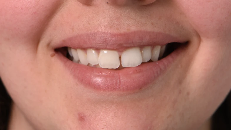 Taches blanches colorées : cas cliniques au cabinet dentaire du Docteur Elodie Bocquet à Douai 59500