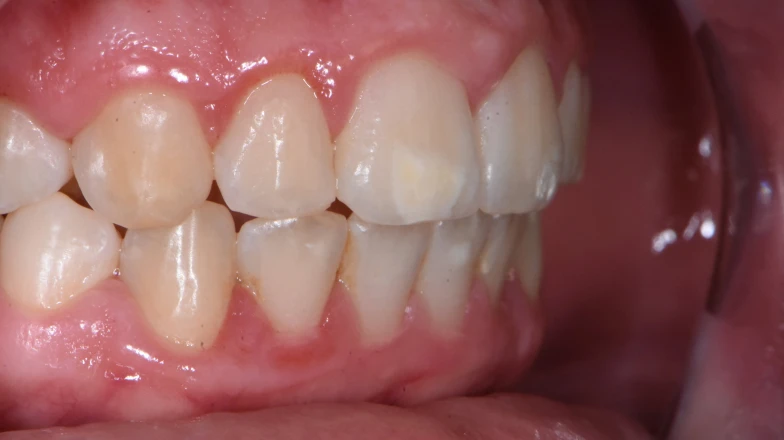 Сas cliniques au cabinet dentaire du Docteur Elodie Bocquet : taches blanches seules