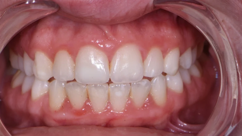 Taches blanches seules : cas cliniques au cabinet dentaire du Docteur Elodie Bocquet à Douai 59500