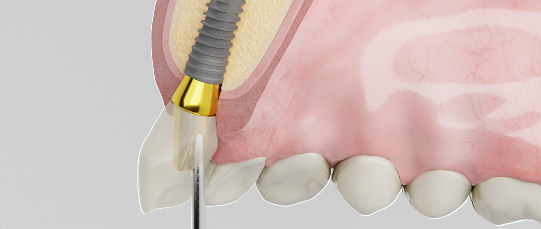 Qu'est-ce qu'un implant ?