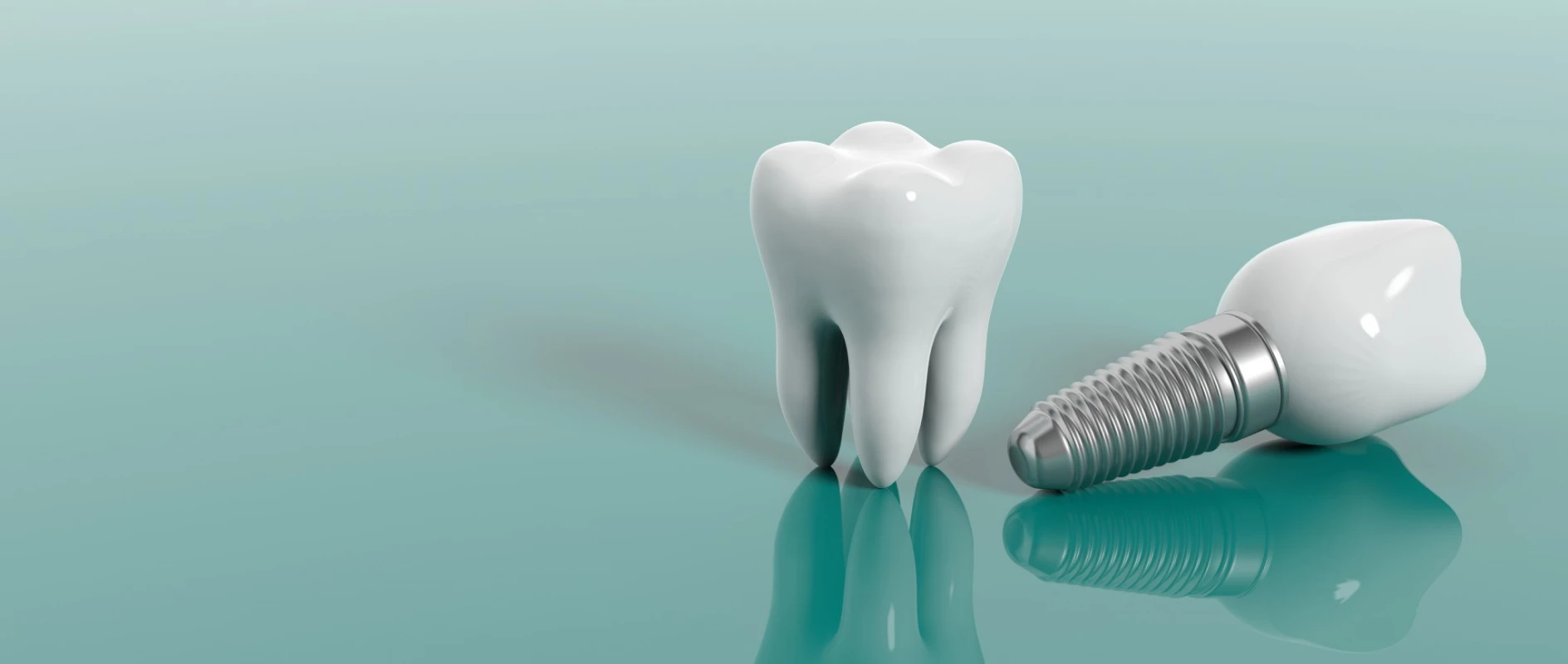 Implant unitaire au lieu d'une dent manquante au cabinet dentaire du Dr Bocquet