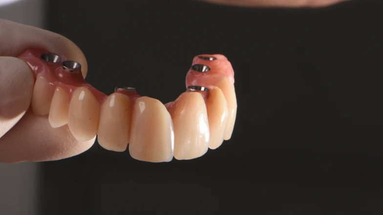 Сas cliniques au cabinet dentaire du Docteur Bocquet à Douai : appareil stabilisé par implant
